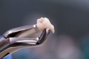 An extracted tooth held by forceps