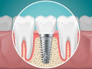 Illustration of a dental implant in a jawbone