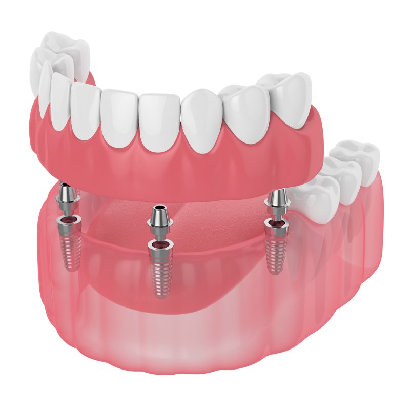 Implant-retained dentures