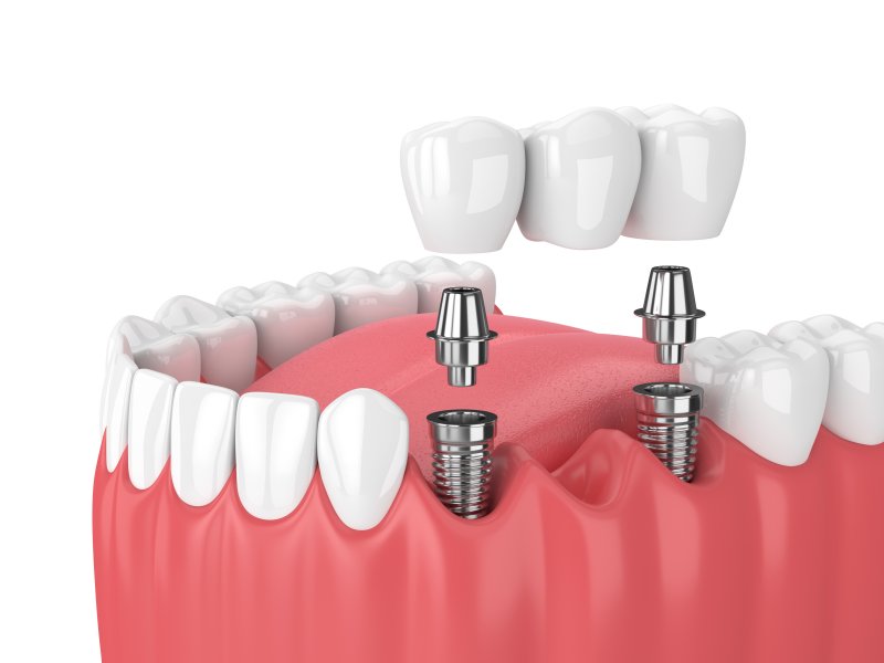 Diagram highlighting types of dental implants in Richardson