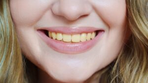 Woman smiling with yellow teeth